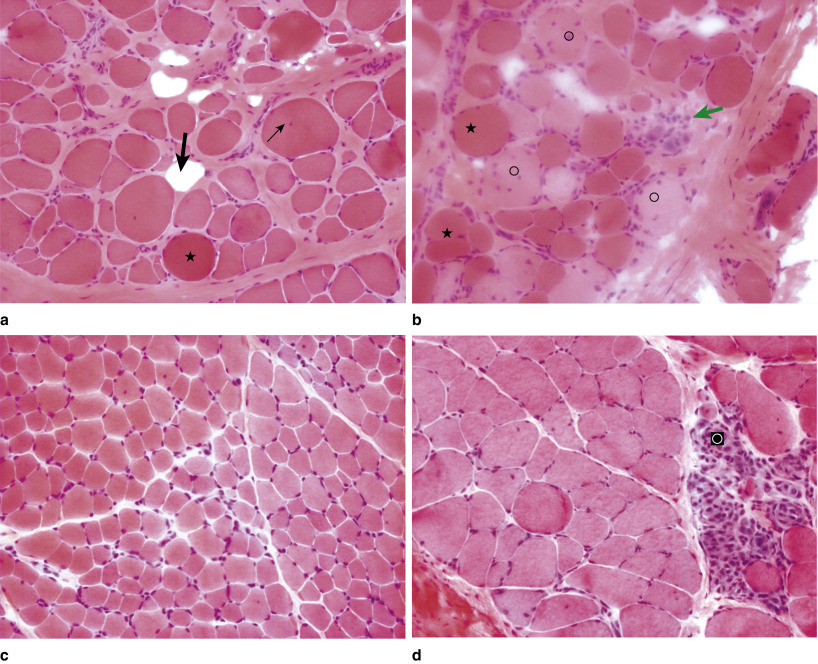 Muscular Dystrophies And Allied Disorders I: Duchenne And Becker ...