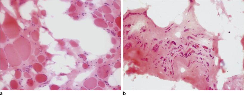 Muscular Dystrophies And Allied Disorders I: Duchenne And Becker ...