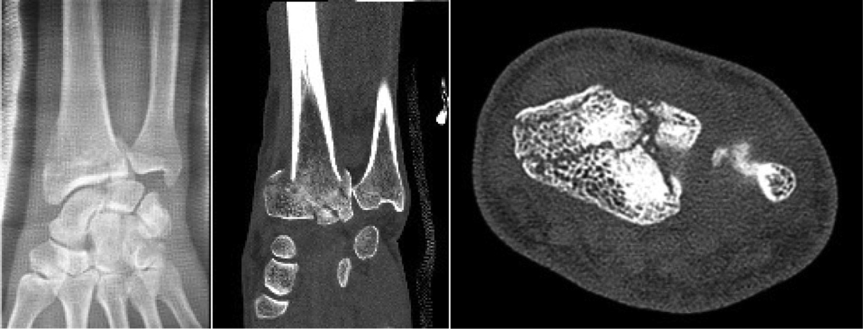 Arthroscopic-Assisted Treatment Of Distal Radius Fractures ...