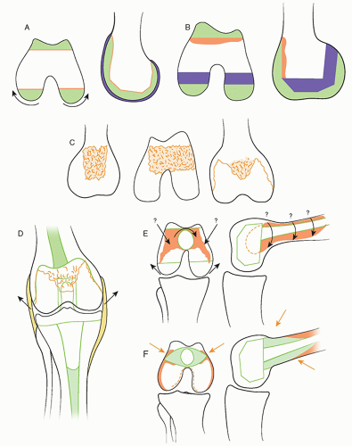 Mobile-Bearing Knee Replacement | Musculoskeletal Key