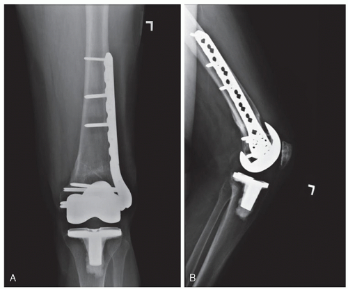 Intraoperative Complications During Total Knee Arthroplasty ...