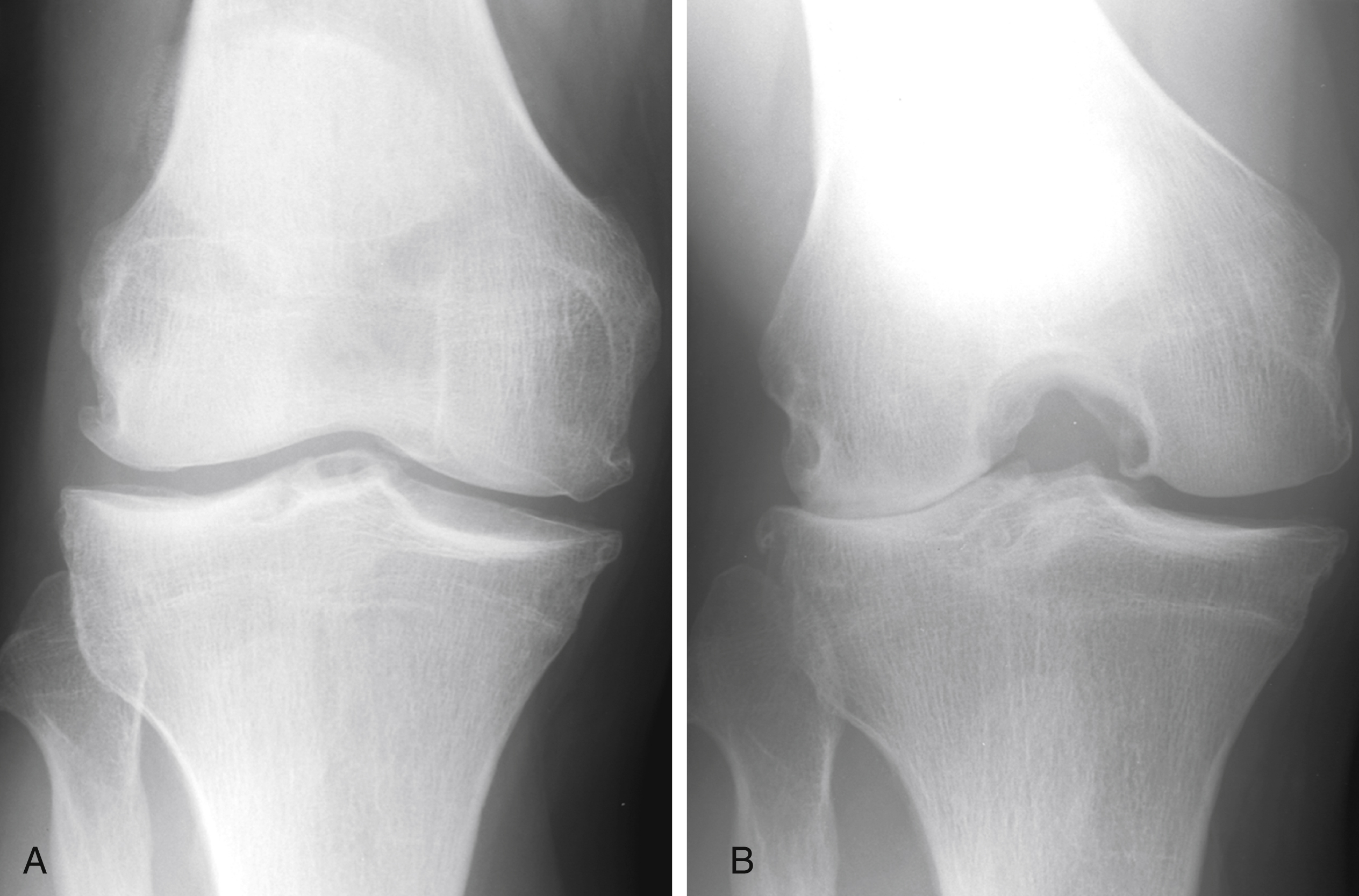 Plain Radiography Of The Knee | Musculoskeletal Key