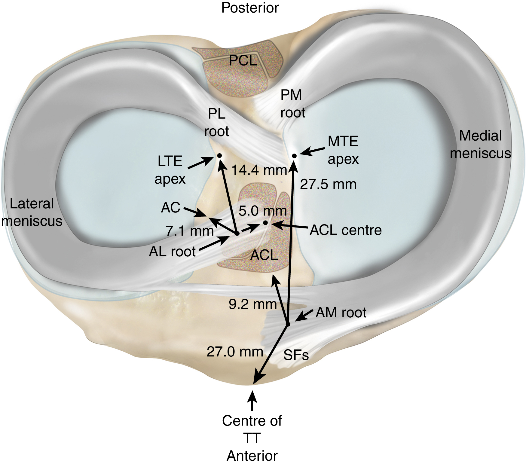 Meniscal Root Tears | Musculoskeletal Key