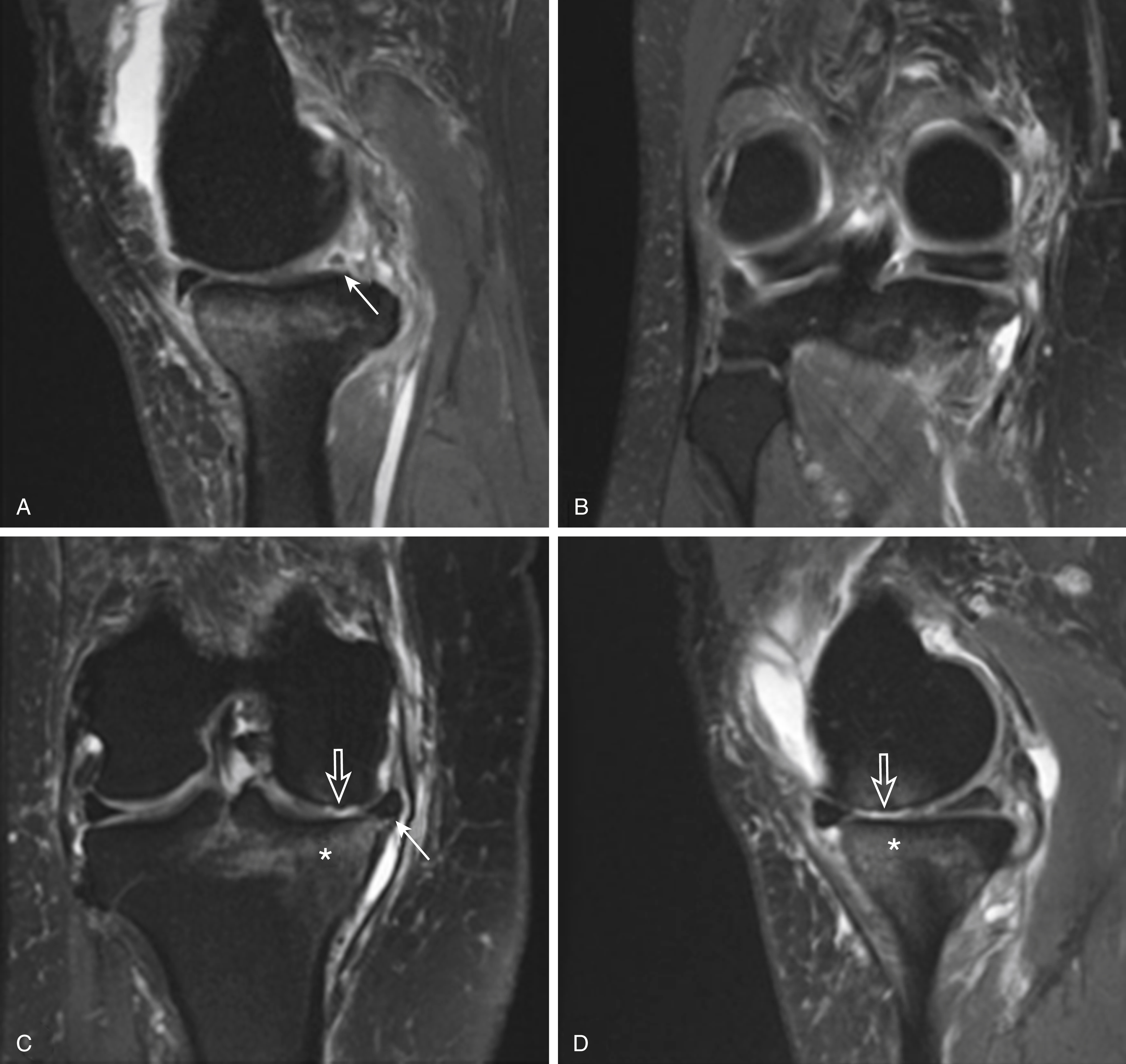 Meniscal Root Tears | Musculoskeletal Key