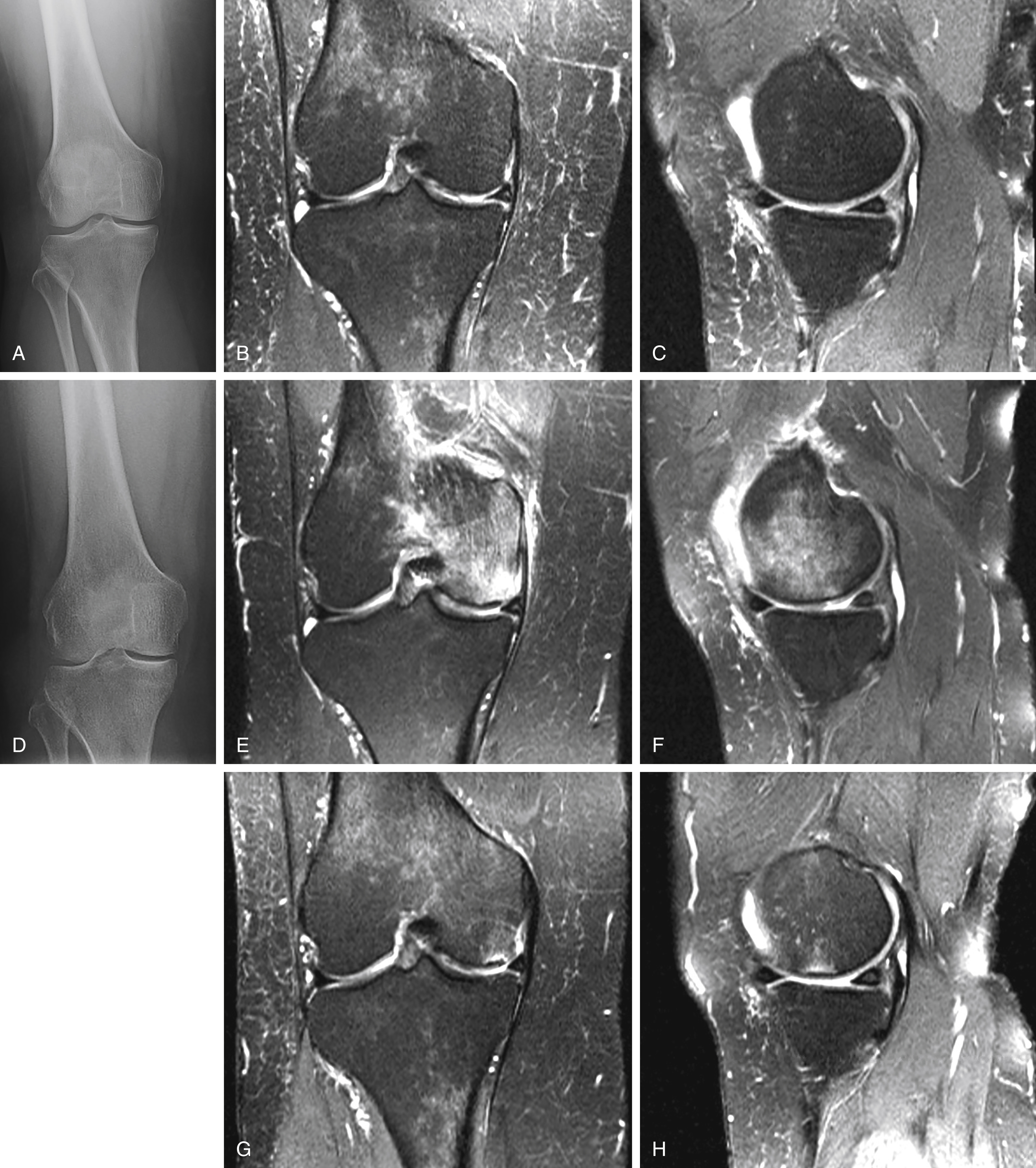 Osteonecrosis Of The Knee | Musculoskeletal Key