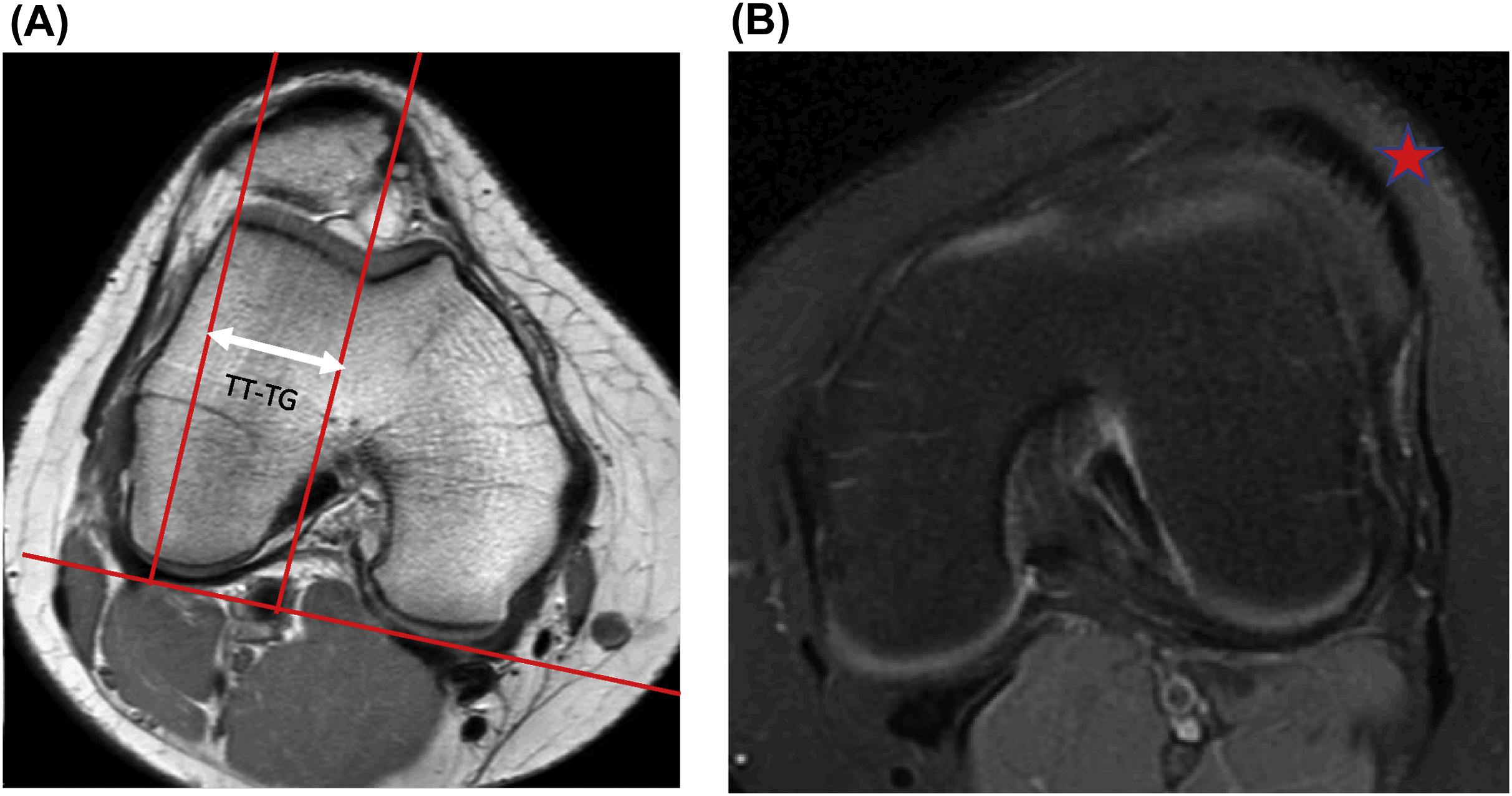 Patellar Instability | Musculoskeletal Key