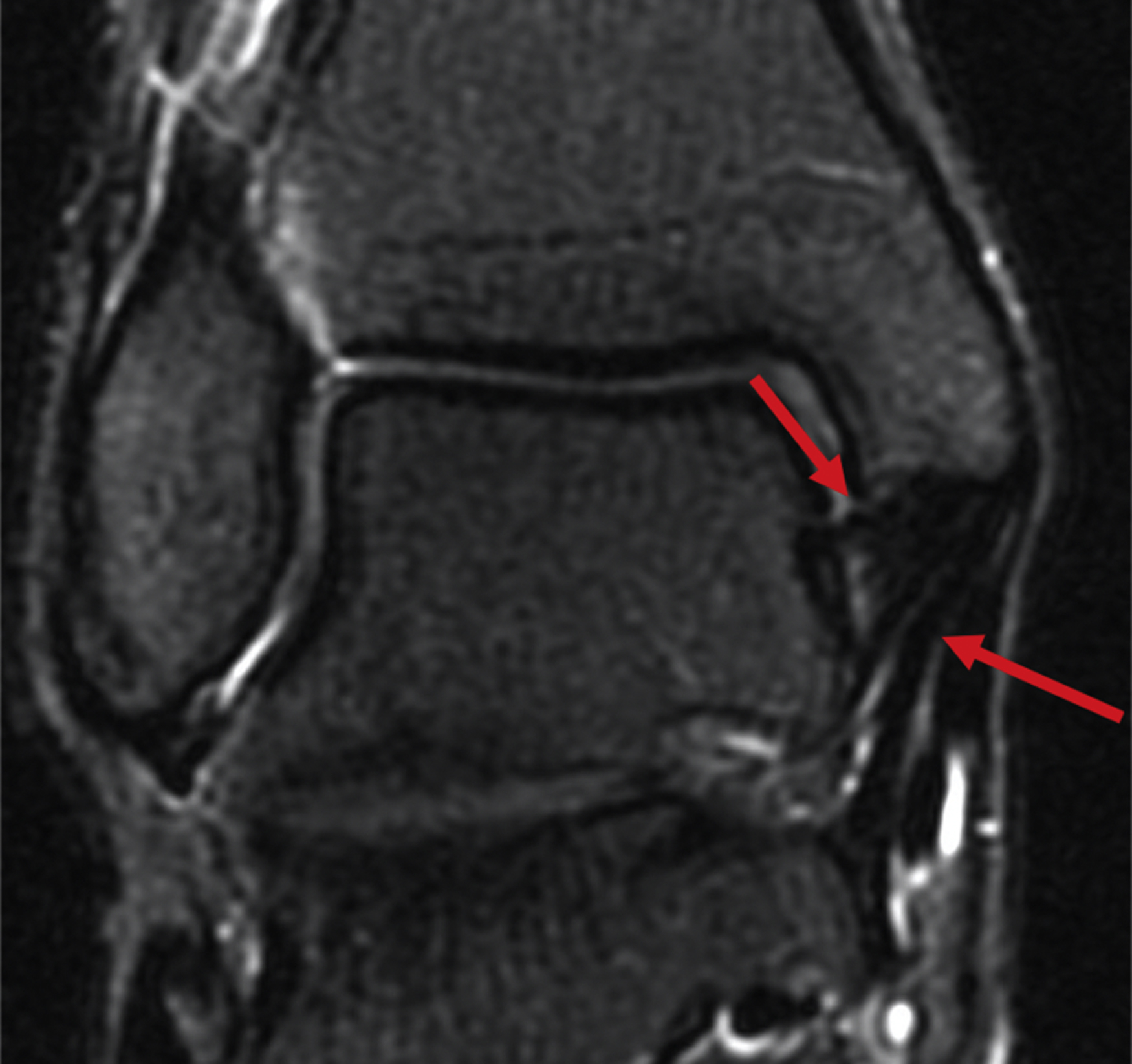 Ankle Anatomy And Biomechanics | Musculoskeletal Key