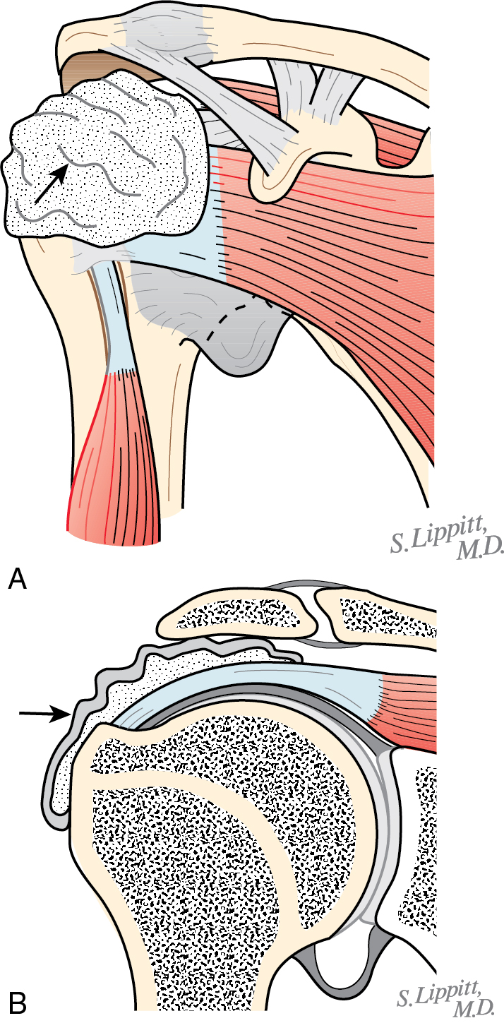 Evaluation Of Rotator Cuff Pathology: History, Examination, And Imaging ...