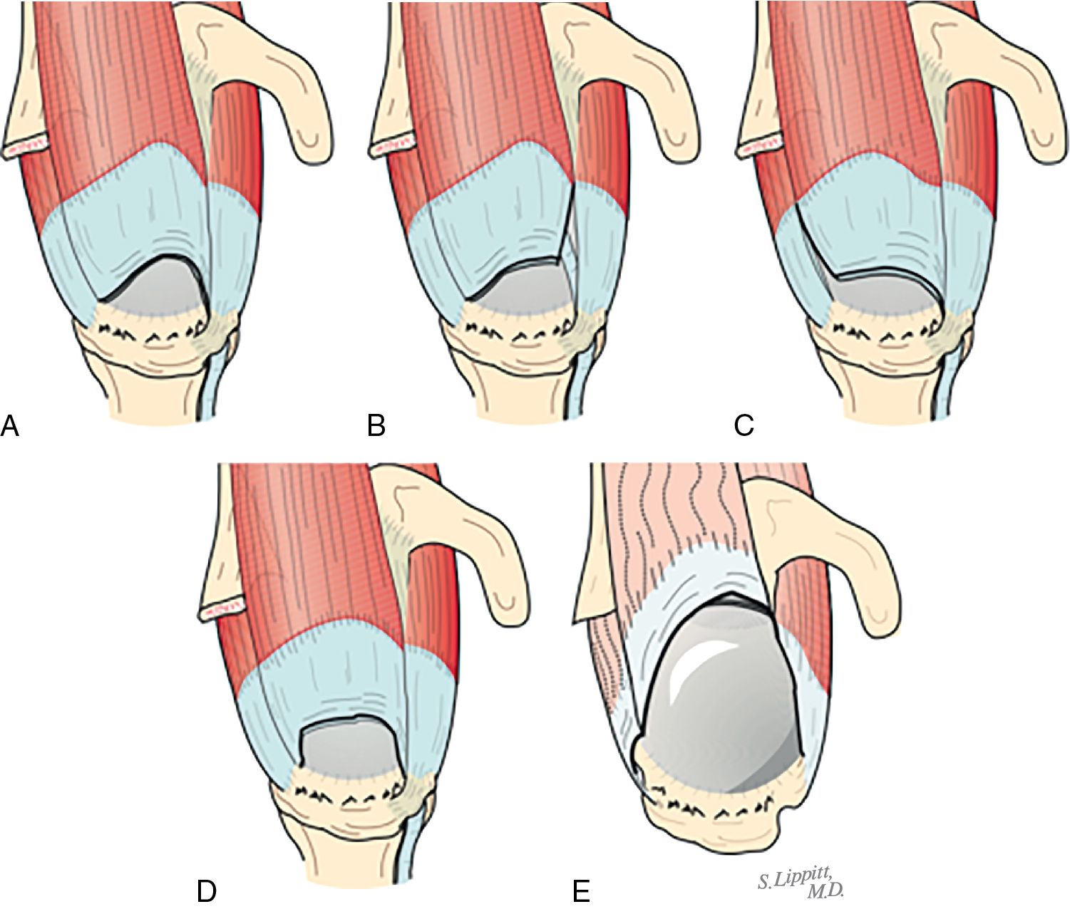 Rotator Cuff Repair: Tear Classification, Operative Techniques, And ...