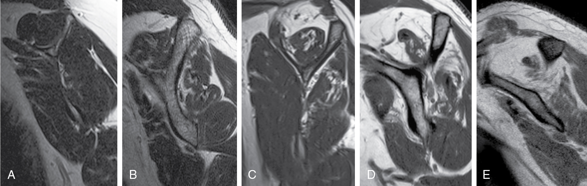 Rotator Cuff Repair: Tear Classification, Operative Techniques, And ...