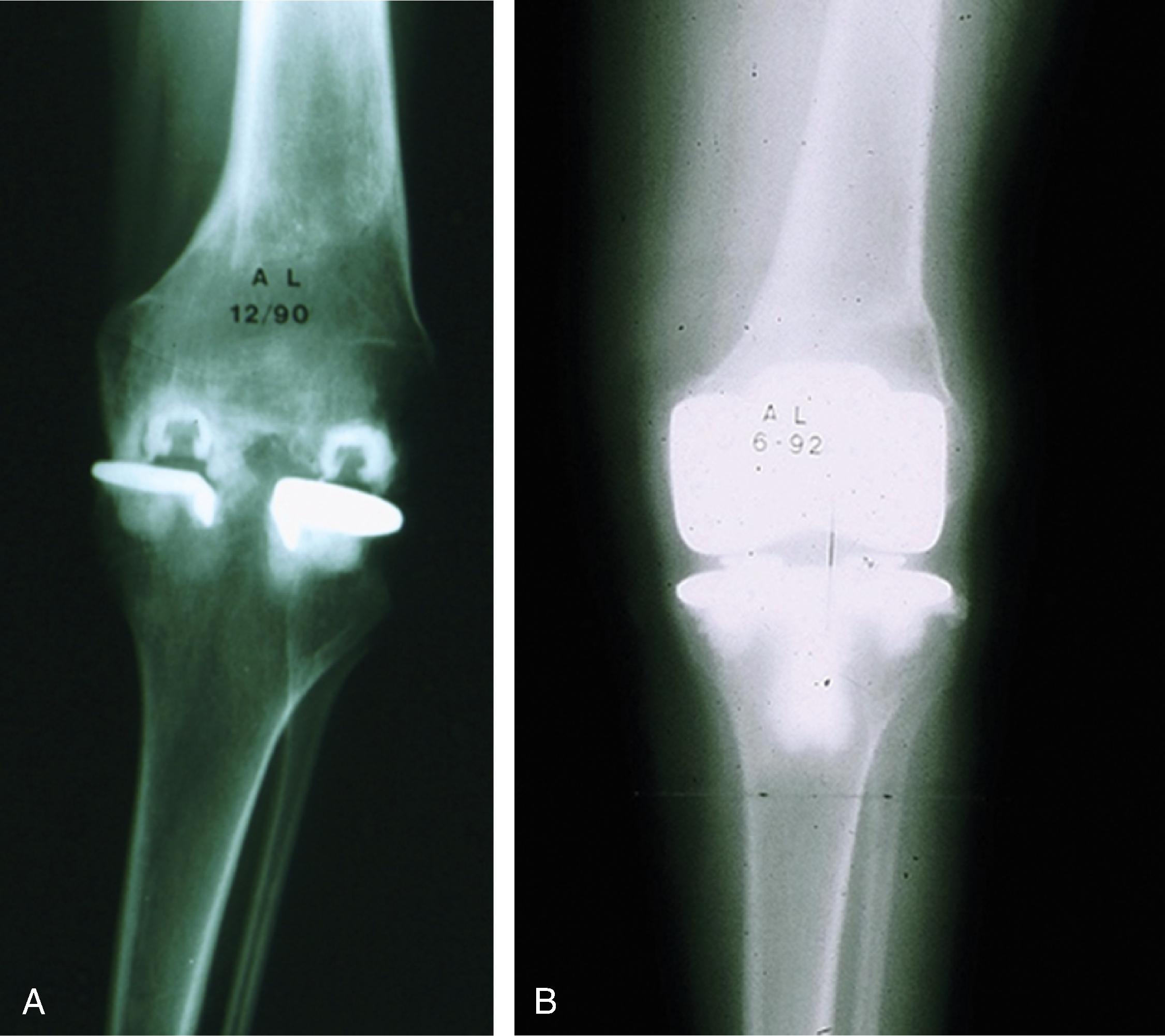 Mechanical Alignment Total Knee Arthroplasty: A Thoughtful Beginning ...