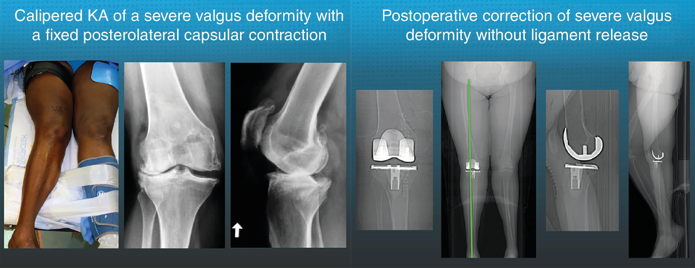 Calipered Kinematic Alignment Total Knee Arthroplasty Performed With ...