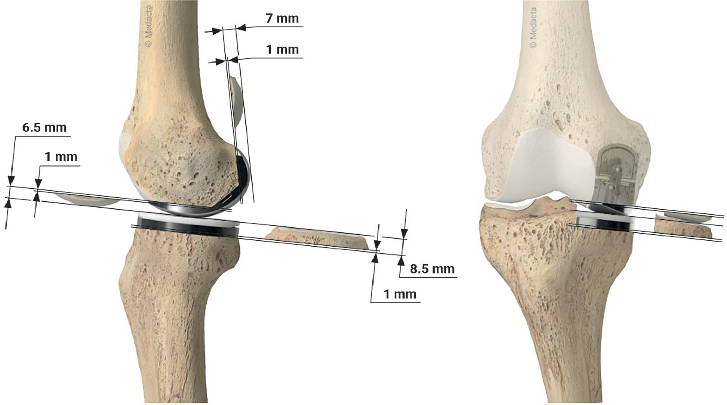 Kinematic Alignment Technique For Unicompartmental Knee Arthroplasty ...