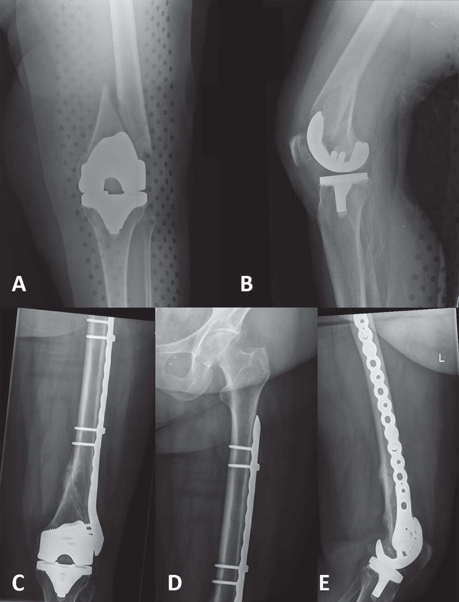 Femoral Shaft Fractures | Musculoskeletal Key