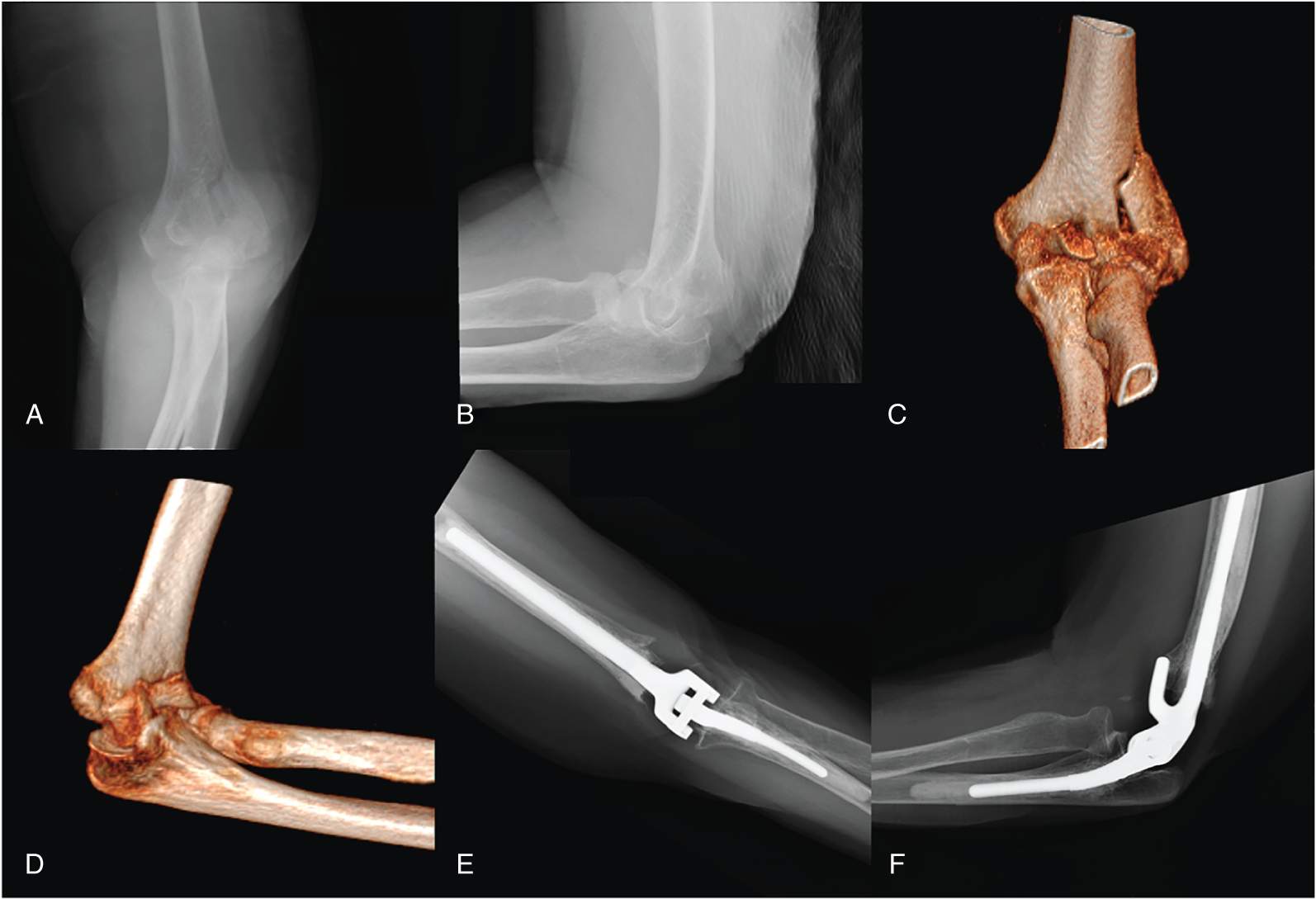 Distal Humerus Fractures | Musculoskeletal Key