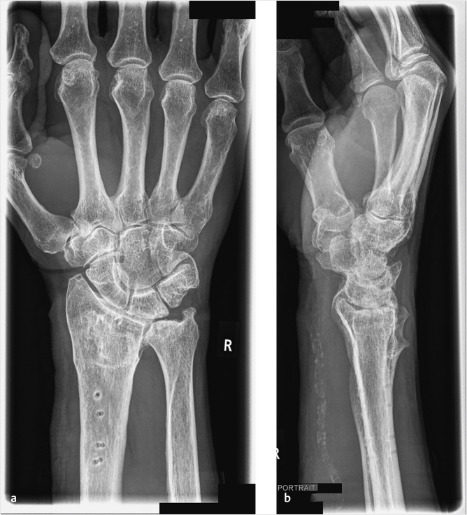 Distal Radius Fracture Malunion | Musculoskeletal Key