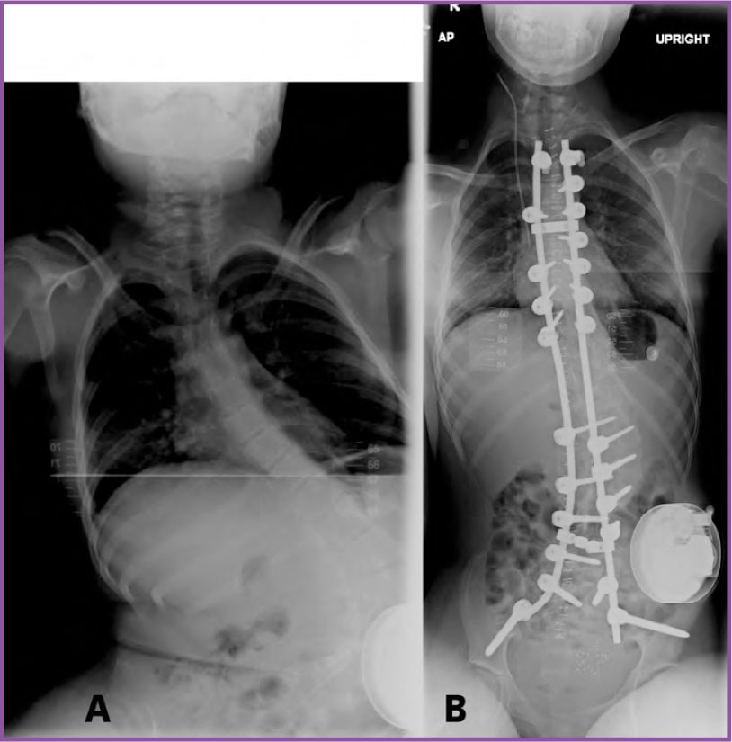 Friedreich Ataxia Musculoskeletal Key