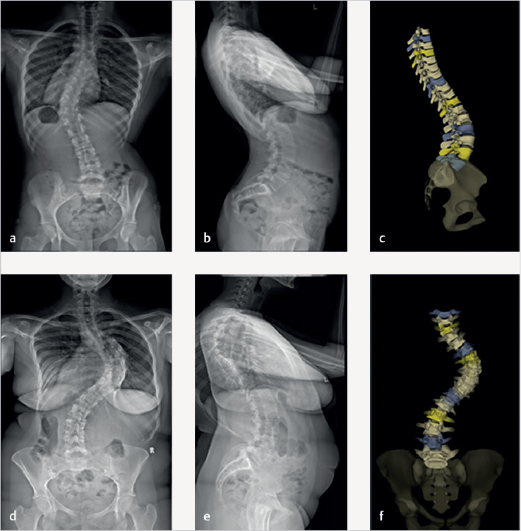 21 Kyphosis Restoration In Adolescent Idiopathic Scoliosis ...