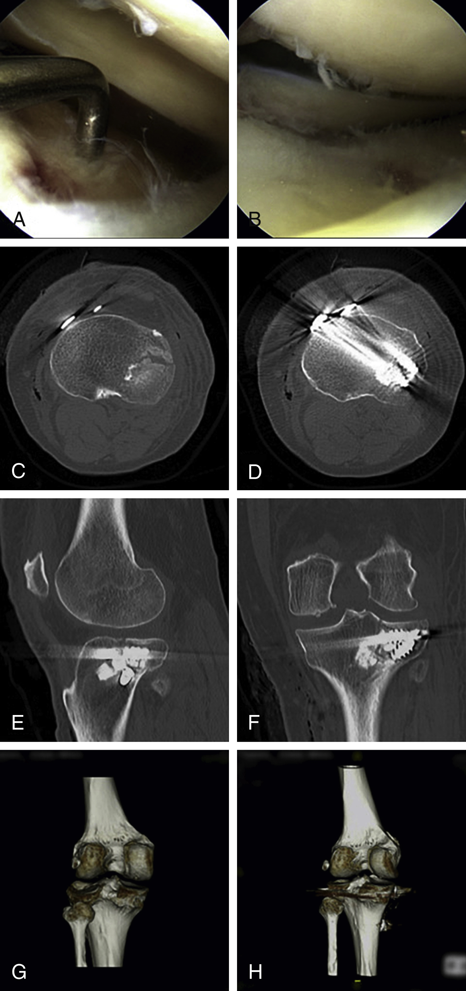 Internal Fixation | Musculoskeletal Key