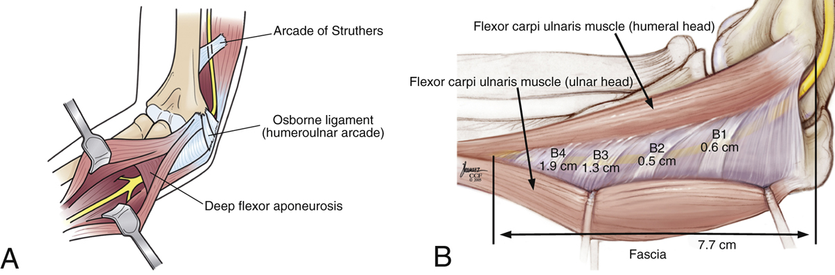 Potential sites of ulnar nerve compression in cubital tunnel syndrome