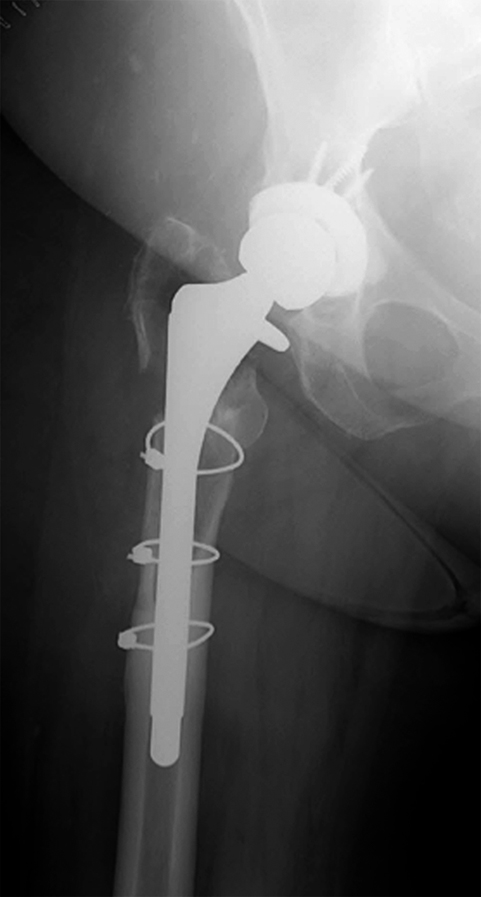 Revision Total Hip Arthroplasty Via Extended Trochanteric Osteotomy ...