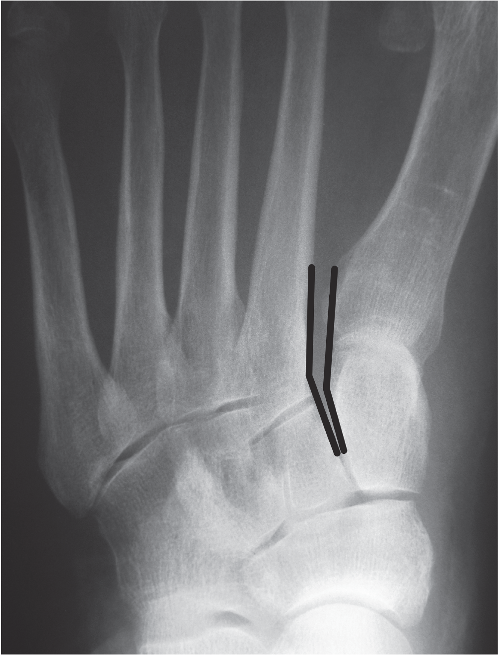 Photo depicts anteroposterior view showing alignment of the lateral borders of the first metatarsal and the medial cuneiform as well as the medial borders of the second metatarsal and the middle cuneiform.