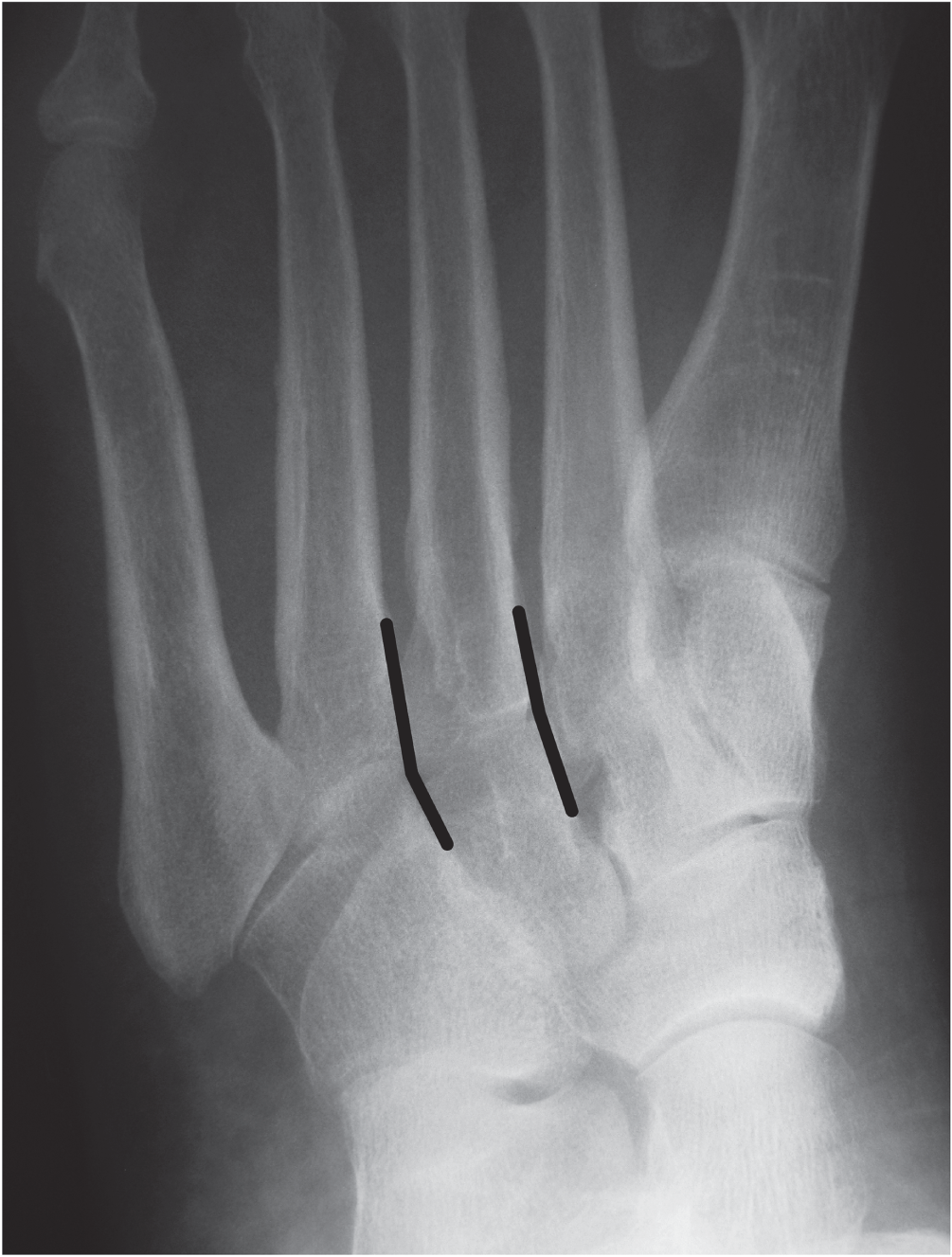 Photo depicts 30° oblique view showing alignment of the medial borders of third metatarsal and the lateral cuneiform as well as the medial borders of the fourth metatarsal and the cuboid bone.
