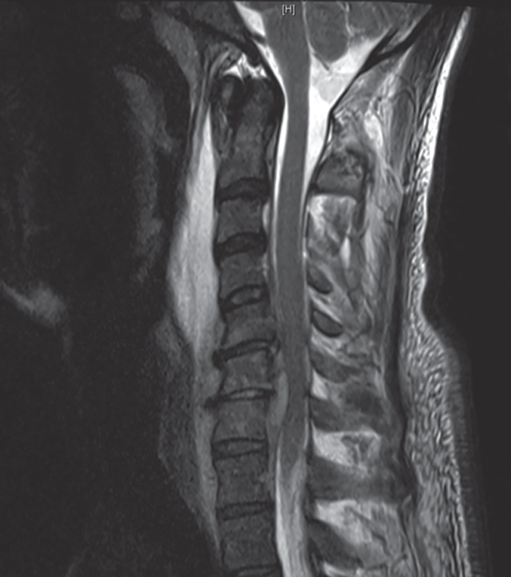 Photo depicts Sagittal T-2 weighted MRI image of a patient with a spinal epidural abscess at C4-T1 and vertebral discitis/osteomyelitis at C5 and C6. The patient was treated with a C6 corpectomy, abscess evacuation and C5-7 reconstruction with instrumentation and a titanium cage.