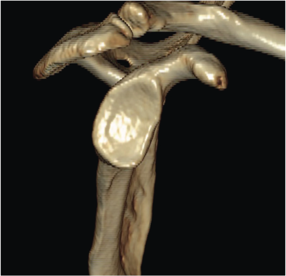 Photo depicts CT scan of the right shoulder, with erosion of the anterior glenoid.