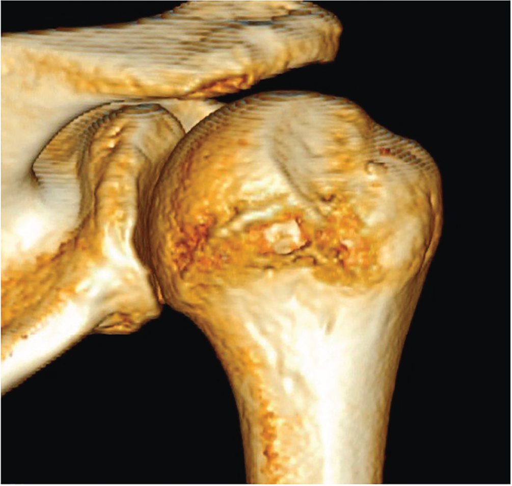 Photo depicts CT scan of the humeral head, showing a Hill-Sachs defect on the posterolateral part of the humeral head.