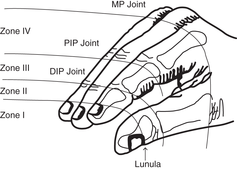 Schematic illustration of Tamai classification of zones in digital amputation: zone I (distal to lunula), zone II (proximal to lunula, distal to DIP joint), zone III (proximal to DIP joint, distal to insertion of FDS tendon), and zone IV (proximal to FDS tendon insertion, distal to MP joint).
