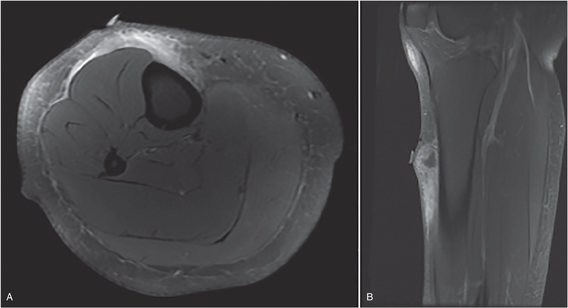 Photos depict T2 weighted images in axial (A) and sagittal (B) view. A hyperintense enhancing signal is extending over 11 cm in the muscle, subcutaneous tissue, along the fascia, and over the tibial periosteum.