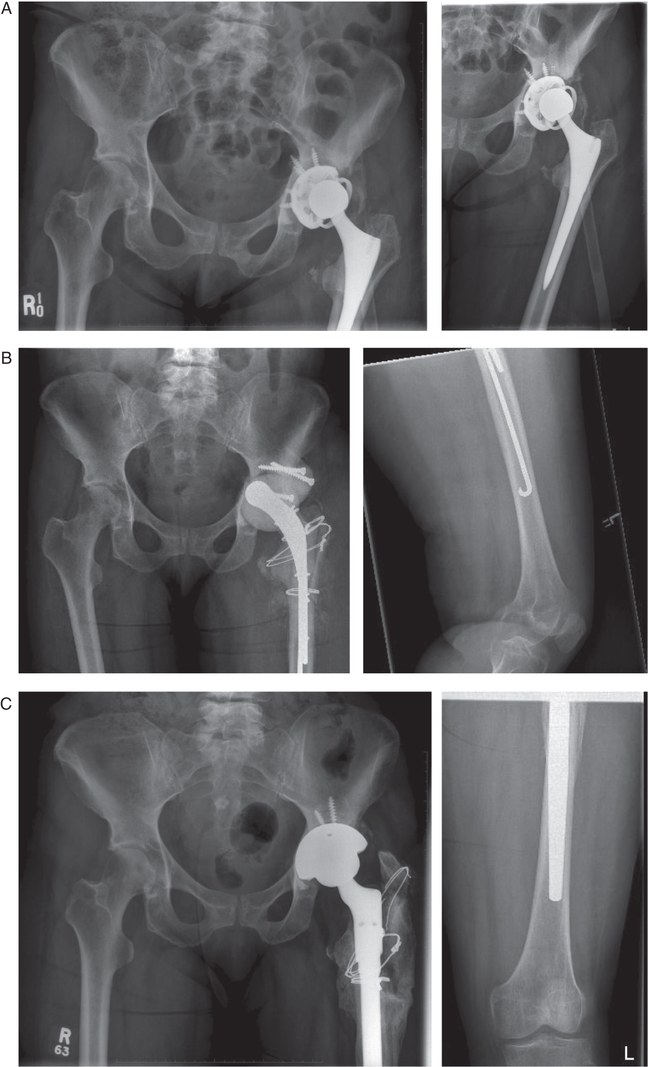 Photos depict Radiographs: (A) preoperative; (B) first-stage; (c) second-stage.