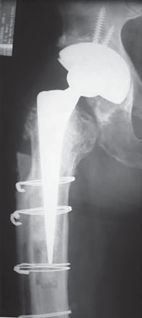 Photo depicts postoperative AP radiograph of the proximal femur showing the revision of a failed THA with impaction allografting and a cortical strut graft for a proximal femoral defect.