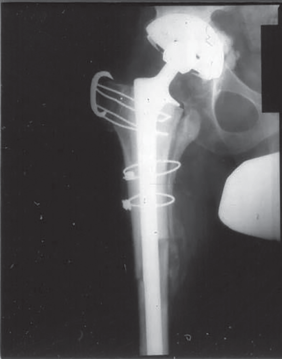 Photo depicts postoperative AP radiograph of the proximal femur showing a long-stemmed implant cemented into a proximal femoral allograft. Note the step-cut junction to enhance junction stability.