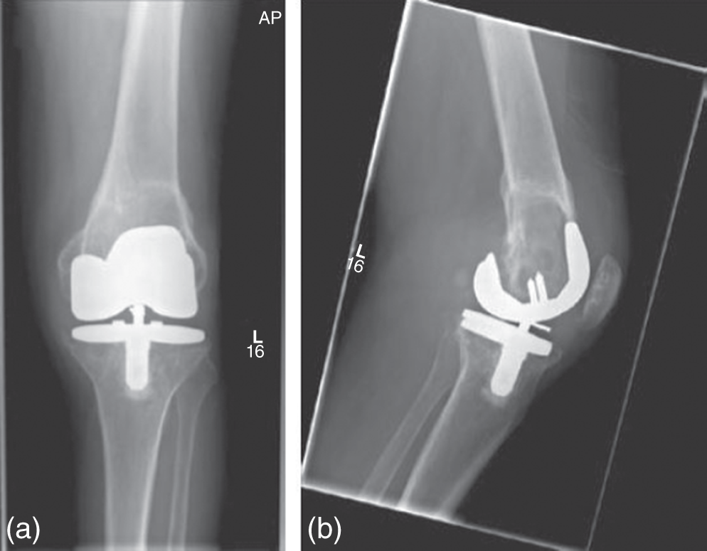 Photos depict CT scan showing femoral bone loss due to osteolysis on cross-sectional imaging in the same 69-year-old patient. Representative (a) sagittal, (b) coronal, and (c) axial images showing degree of bone loss.