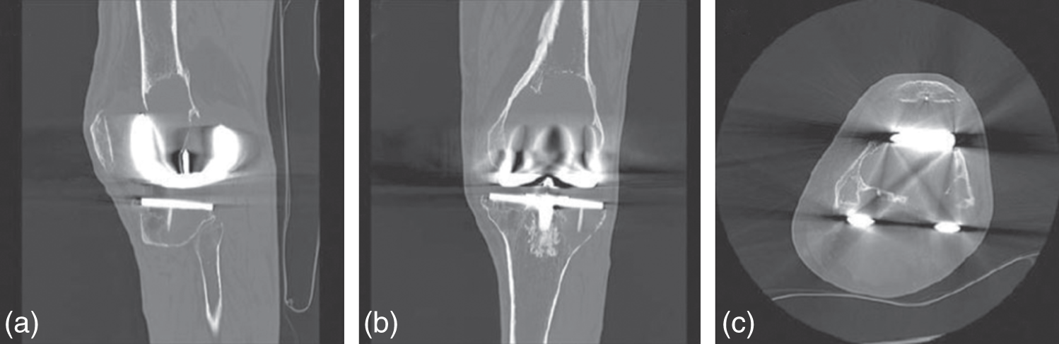 Photos depict representative radiographs of 69-year-old man with osteolysis around TKA implants. (a) Anteroposterior and (b) lateral radiographs of TKA with femoral bone loss secondary to osteolysis.