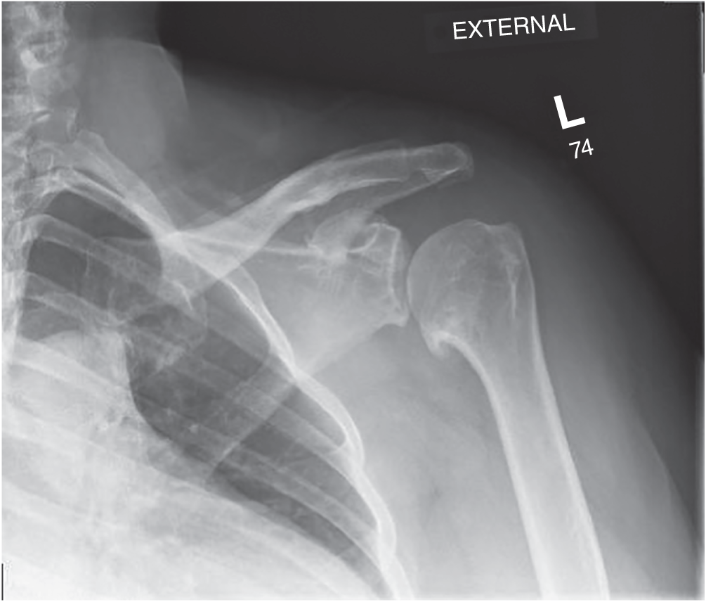 Photo depicts True AP radiograph of the left shoulder shows joint space collapse, subchondral sclerosis, inferior humeral osteophytes and medialization of the humerus without signs of rotator cuff insufficiency.