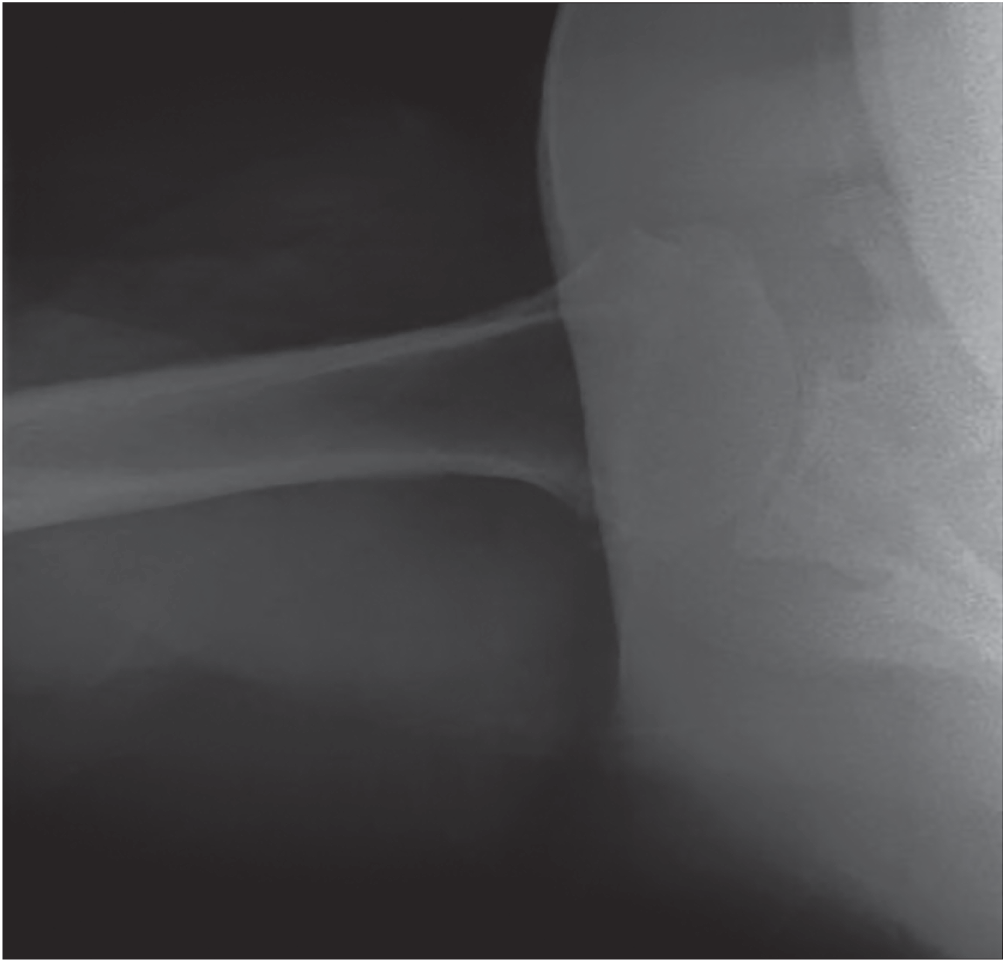 Photo depicts axillary radiograph of the left shoulder showing concentric glenohumeral joint space loss without subluxation of the humeral head or any eccentric ware.