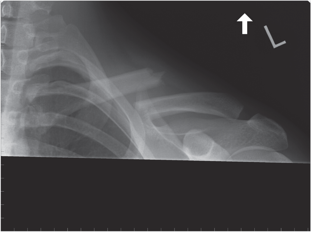 Photo depicts radiograph of a 30-year-old man who fell off his mountain bike and sustained a midshaft clavicle fracture. Displacement and shortening is evident.