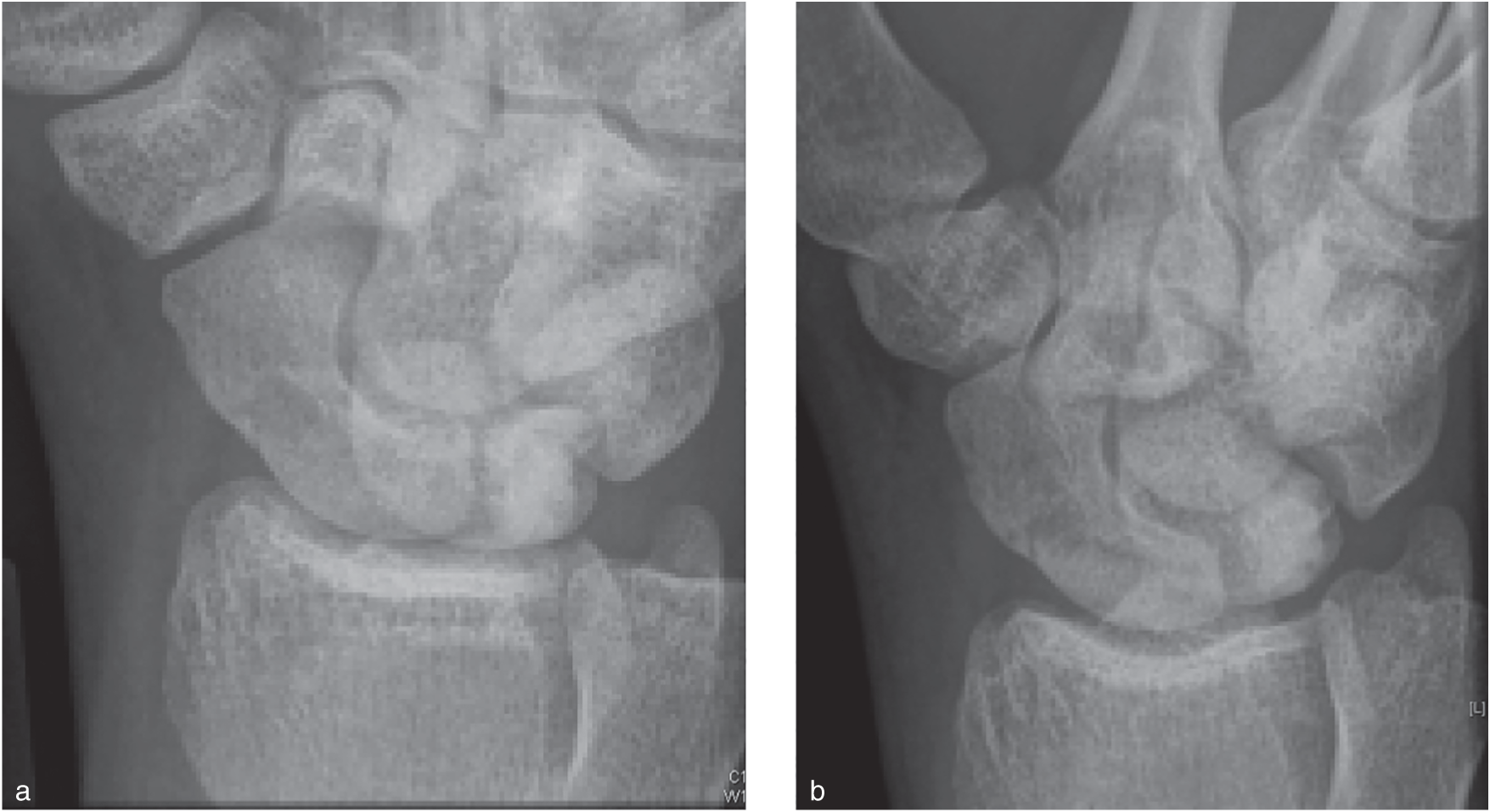 Photos depict Pronated oblique view of the same patient in Figure 89.1: (A) following the injury, there was a doubt about a waist fracture; (B) 10 days later, radiograph reveals more clearly the waist fracture.