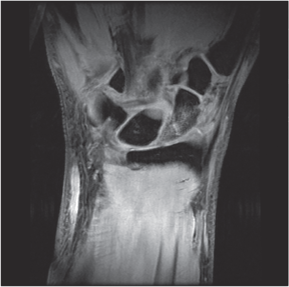 Photo depicts Coronal Fat Sat T2 MRI confirming a suspected proximal pole fracture of the scaphoid.
