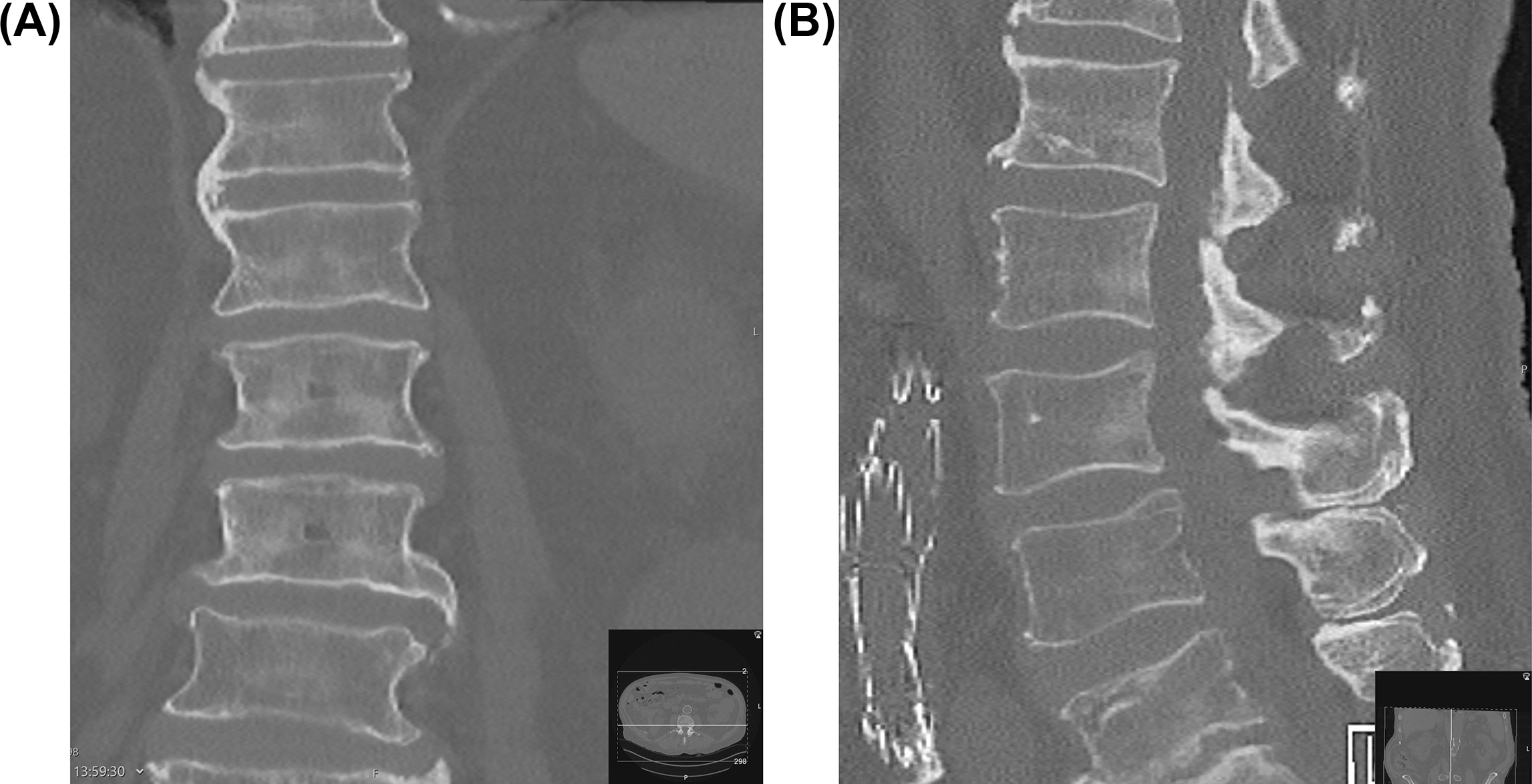 Osteophyte Formation Lumbar Spine