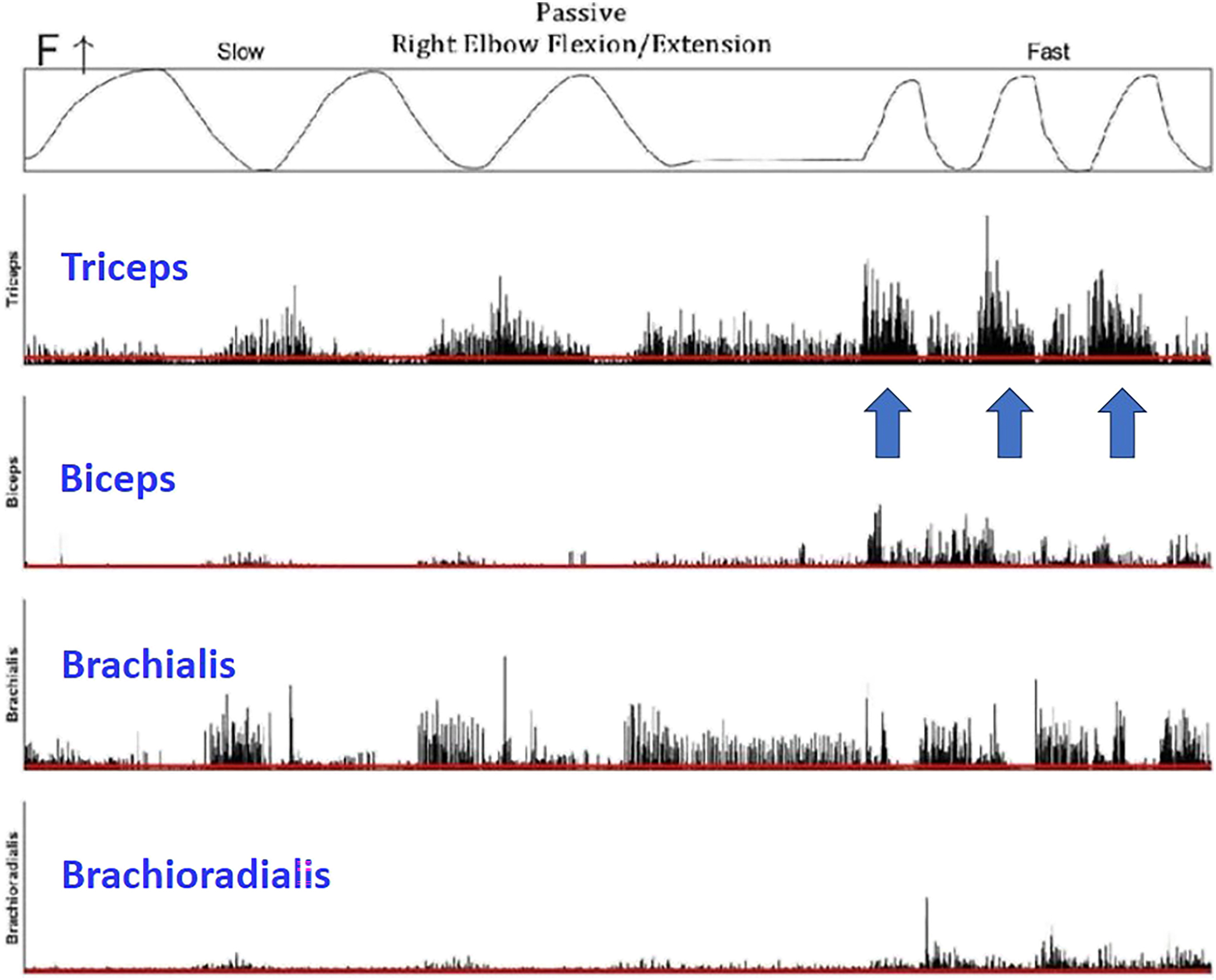 A scan displays a dynamic electromyography recording of the right elbow during passive flexion and extension, showing involuntary triceps firing during fast motion marked by three arrows.