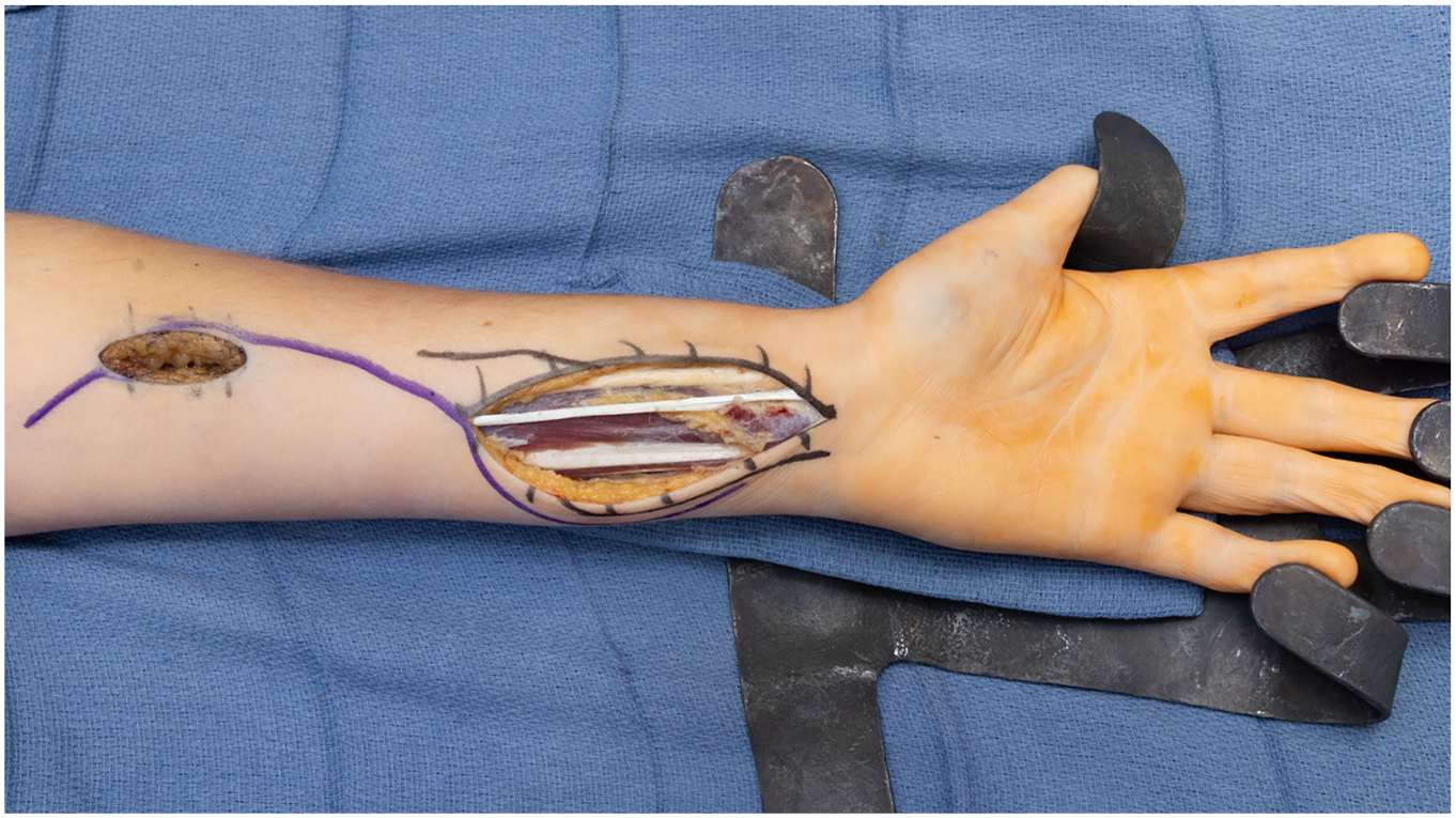 A surgical photo of a volar forearm with a drawn curvilinear and proximal longitudinal incision shows exposure of the pronator teres, wrist, and finger flexor tendons on a surgical drape.