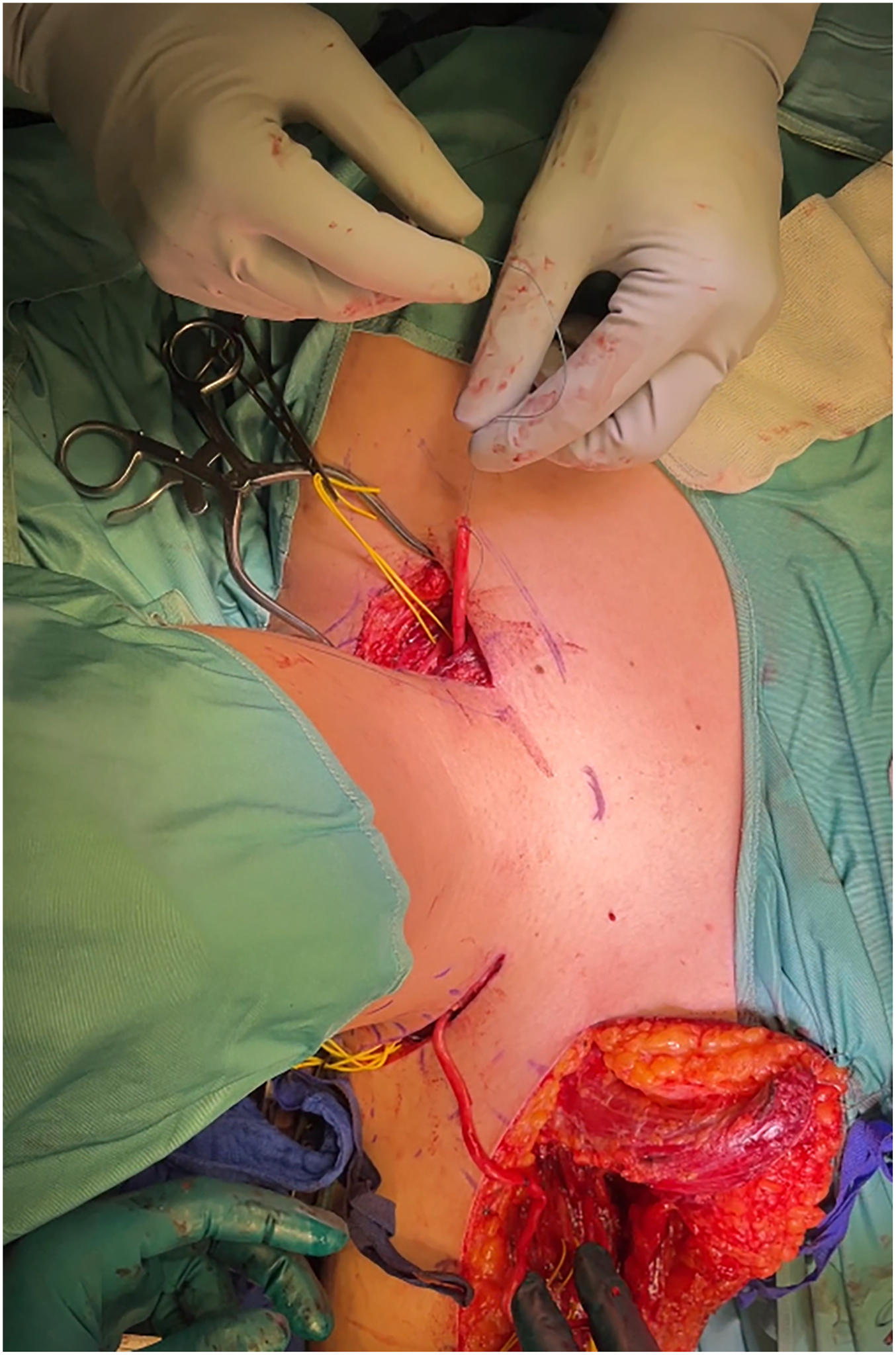 A surgical photo shows contralateral C 7 nerve transfer with the ulnar nerve graft tunneled subcutaneously and prepared for coaptation between donor and recipient nerves.