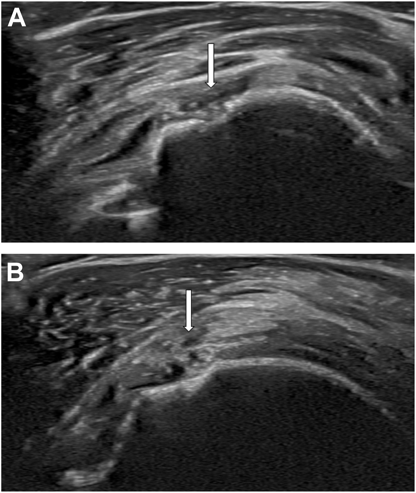 Two ultrasound illustrations show a full-thickness supraspinatus tendon tear in a wheelchair athlete, with the tear indicated by a white arrow in long and short axis views.