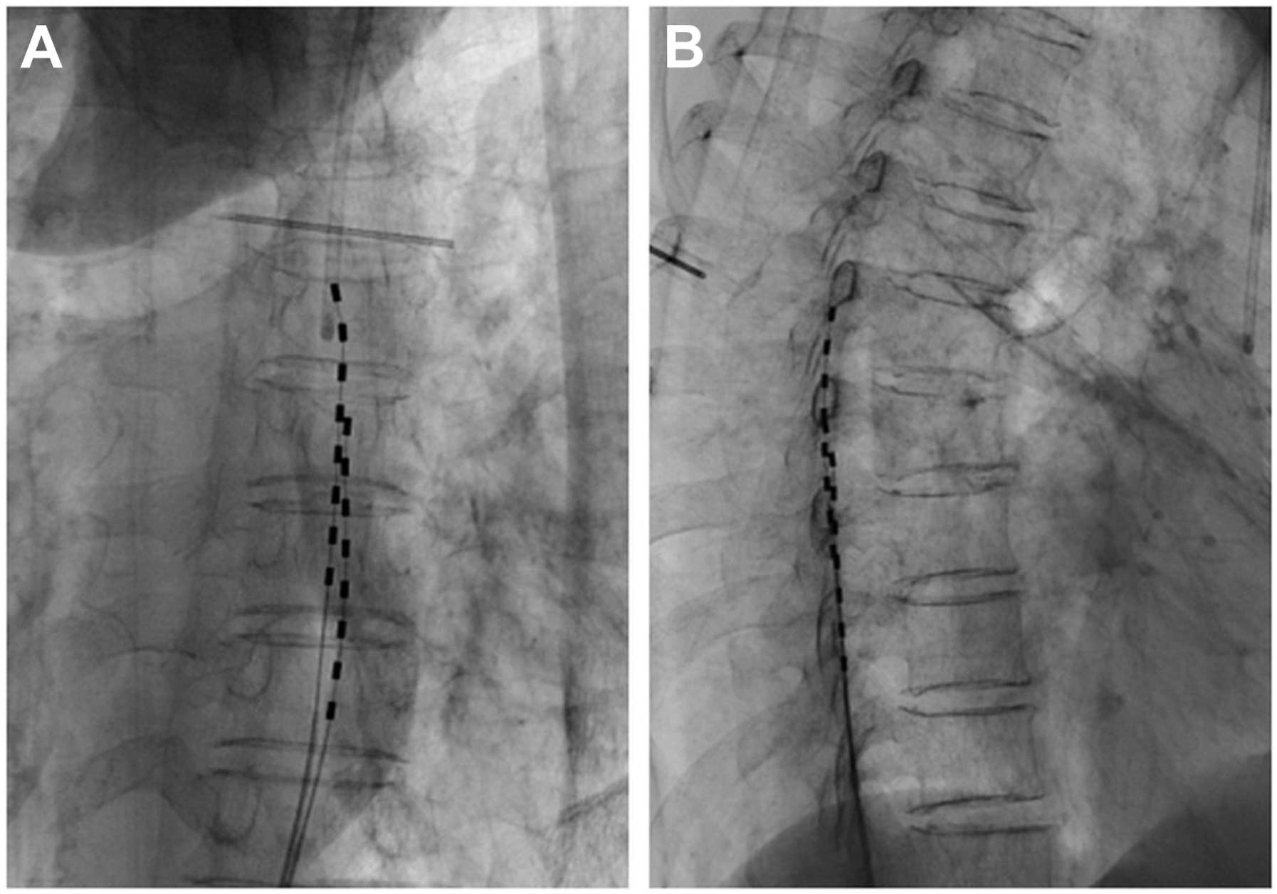 A two-panel fluoroscopic radiograph shows the anteroposterior and lateral views of traditional spinal cord stimulation leads implanted along the thoracic spine.