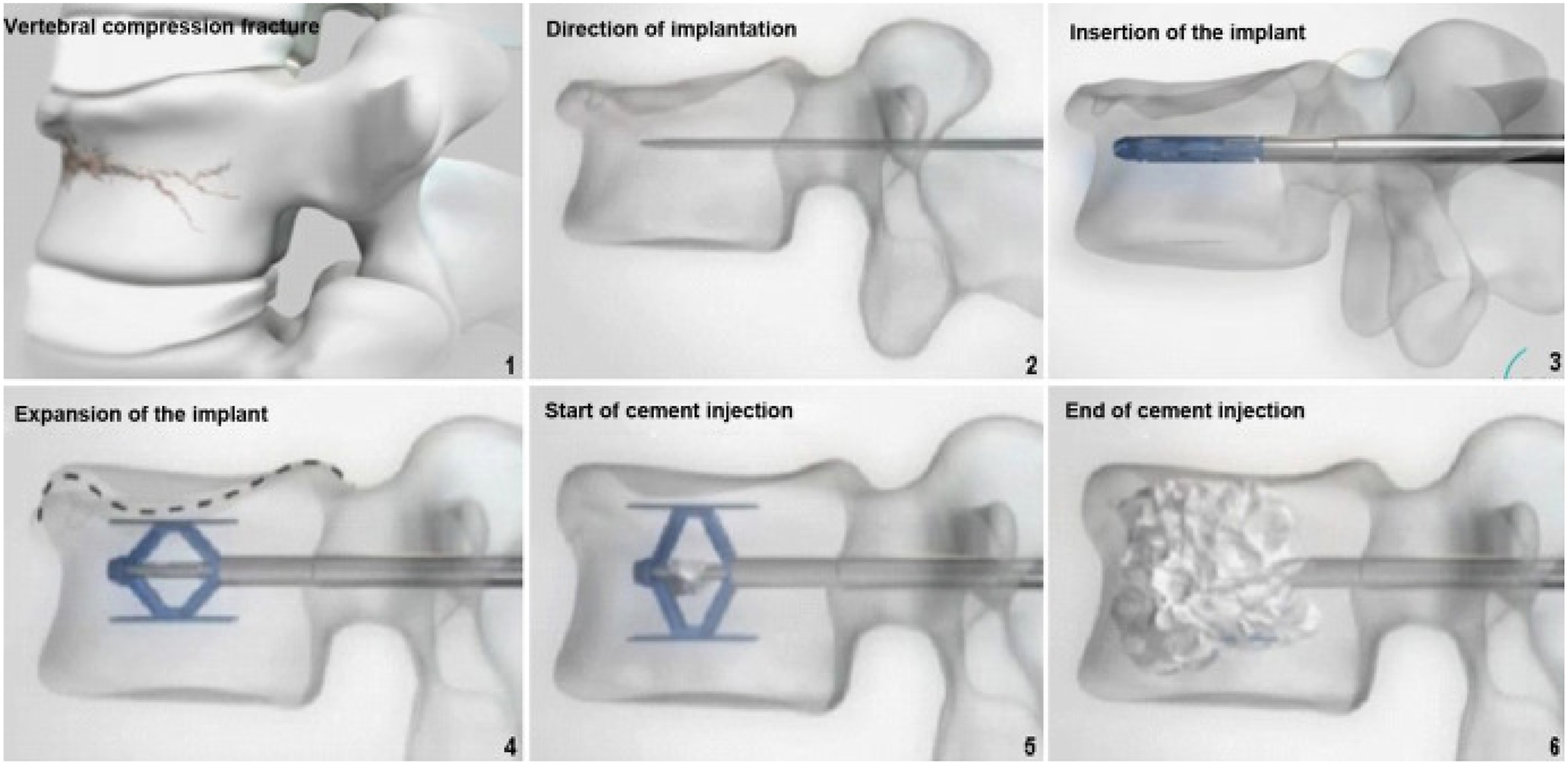 A six-step medical illustration shows the surgical procedure of a SpineJack implant expanding within a fractured vertebra before the injection of bone cement.