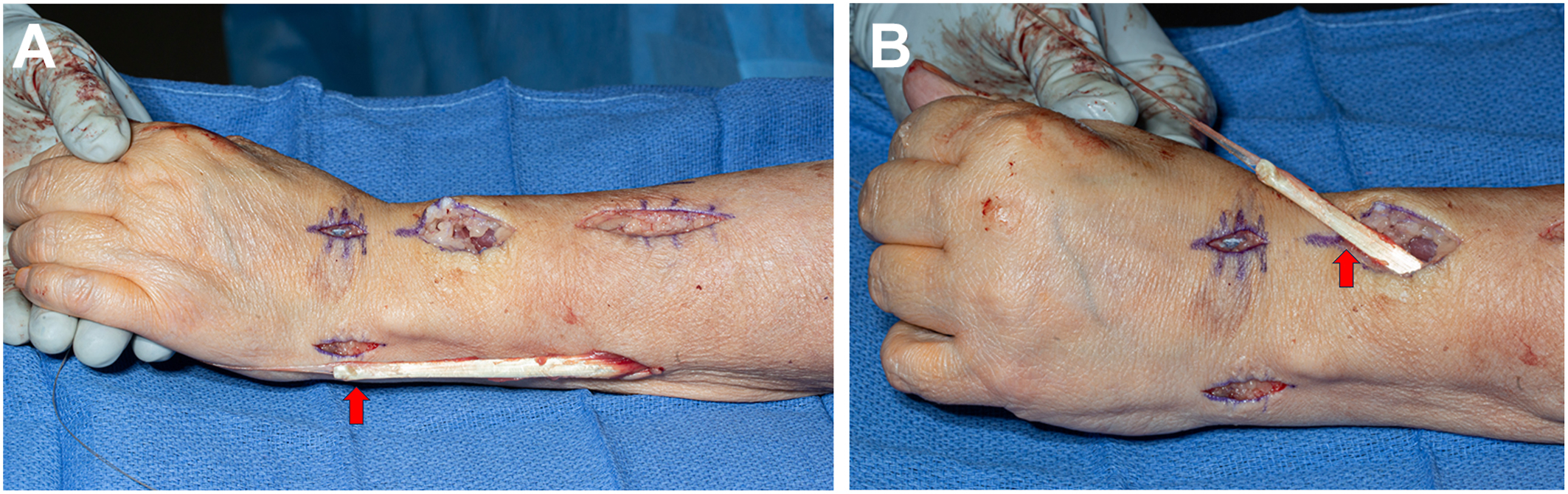 Two surgical photos of the dorsal forearm and hand with surgical incisions show the extensor carpi ulnaris rerouted toward the extensor carpi radialis brevis to improve wrist extension.